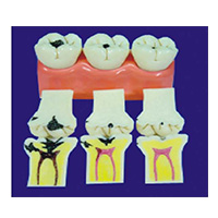 Dissected Carious Teeth Model LT-Y10009-1 